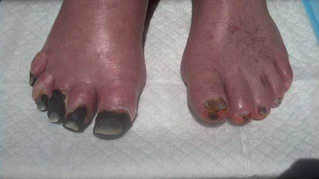 Gangrene on toes and nutrition