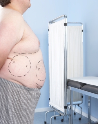 Weight Loss Surgery: A Weight Loss Plan for the Toughest Cases