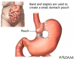 Surgical Weight Loss