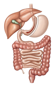 Gastric Sleeve