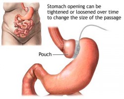 The Risks of Gastric Bypass Surgery