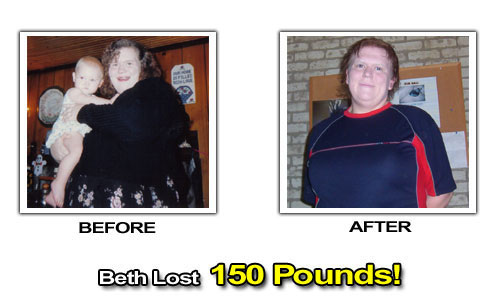 Weight Loss Stories – Beth Lost 150 Pounds