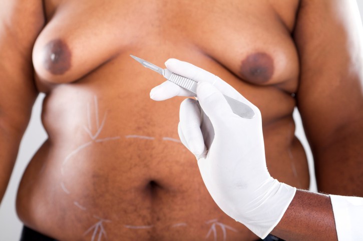 Liposuction: Is It For You?