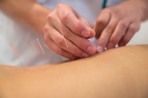 Acupuncture tops drug for back pain relief: Study