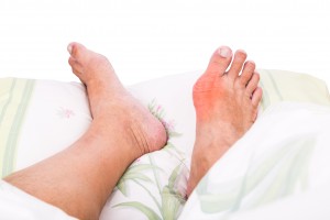 Rheumatoid arthritis vs. gout, differences in symptoms, causes, and treatment