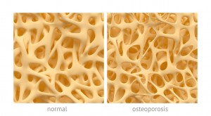 Psoriasis or psoriatic arthritis patients show higher osteoporosis and osteopenia prevalence: Study