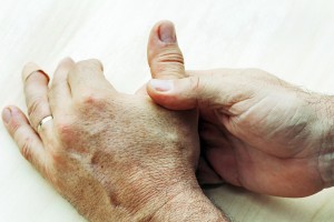 Rheumatoid arthritis vs. osteoarthritis, differences in symptoms, causes, and treatment