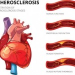 Scleroderma Awareness Month: Systemic sclerosis, atherosclerosis, interstitial lung disease, GERD risk, and heartburn