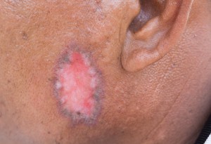 Psoriasis vs. ringworm, differences in symptoms, causes, and treatments