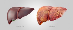 Liver Cirrhosis: Causes, symptoms and prevention