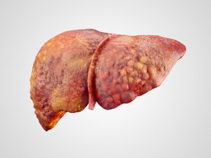 Fatty liver and diabetes risks for liver fibrosis