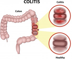 Inflammatory bowel disease (IBD) and irritable bowel syndrome (IBS) may share symptoms but are not the same