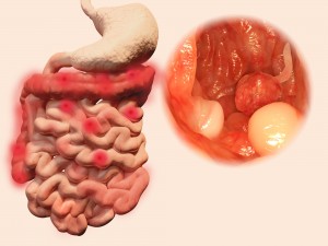 Crohn’s disease, ulcerative colitis, and colon cancer treated with experimental breakthrough therapy