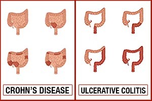 Crohn’s disease vs. ulcerative colitis, differences in symptoms, causes, and treatment