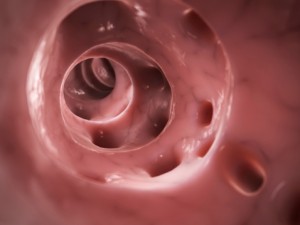 Ulcerative colitis vs. diverticulitis: Causes, symptoms, risk factors, and complications