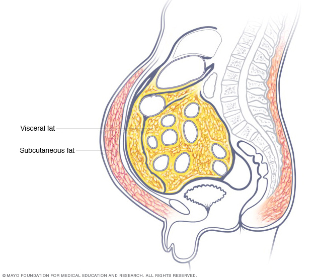 Belly fat in men: Why weight loss matters