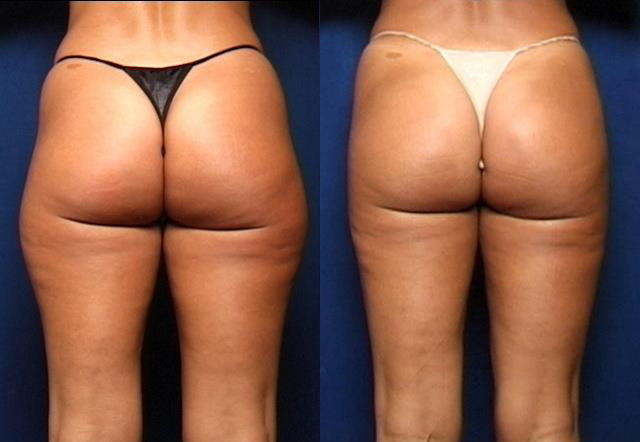 Liposuction: Get Acquainted with some Essential Facts!